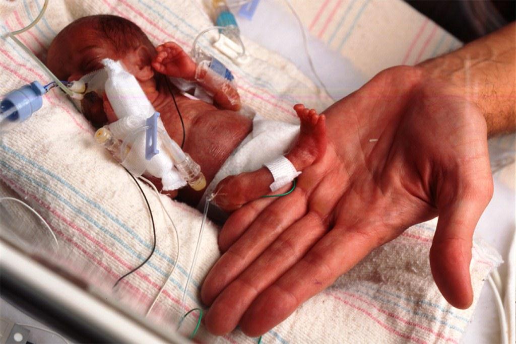 La medicina celebra a dos bebés milagro, nacidos con menos de 300 gramos de peso
