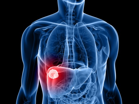 Una nueva red de proteínas interviene en la fase inicial del cáncer de hígado