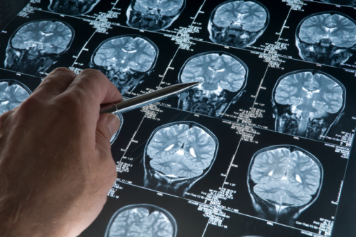La degeneración cerebral por el Alzheimer se produce 15 años antes que los síntomas