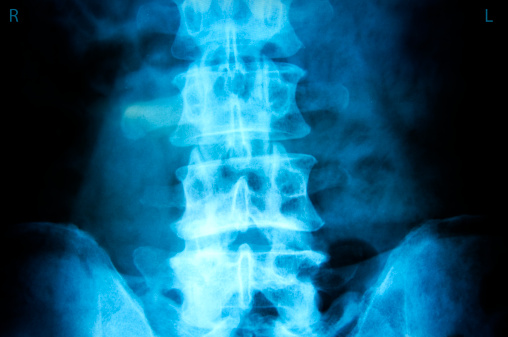 ¿Cuáles son los síntomas de una hernia discal?