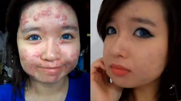 Una joven canadiense arrasa en internet dando trucos para maquillar el acné