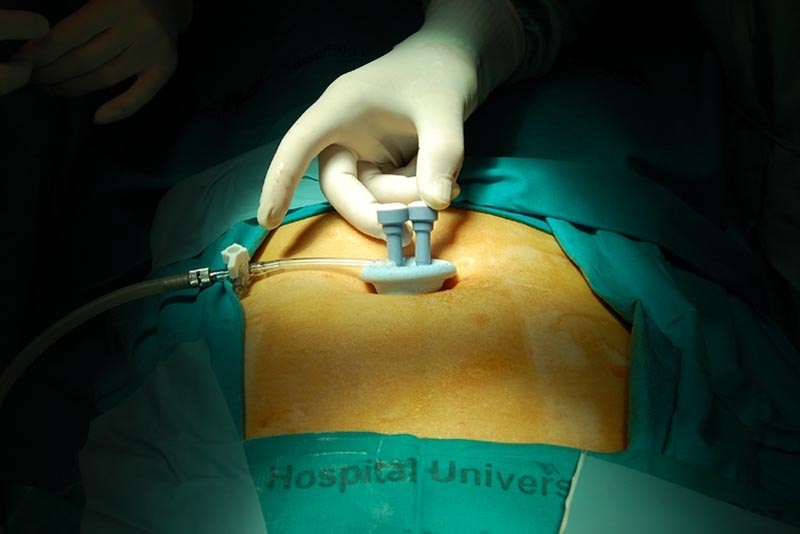 La Paz incorpora a su cartera de servicios la laparoscopia en 3D para cirugía ginecológica
