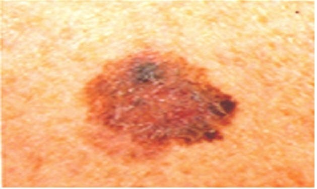 ¿Cuál es la incidencia del cáncer cutáneo no melanoma respecto al melanoma?