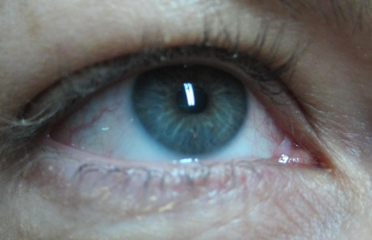 Científicos del CSIC desarrollan un nuevo biomaterial para implantar en el ojo que puede frenar la DMAE