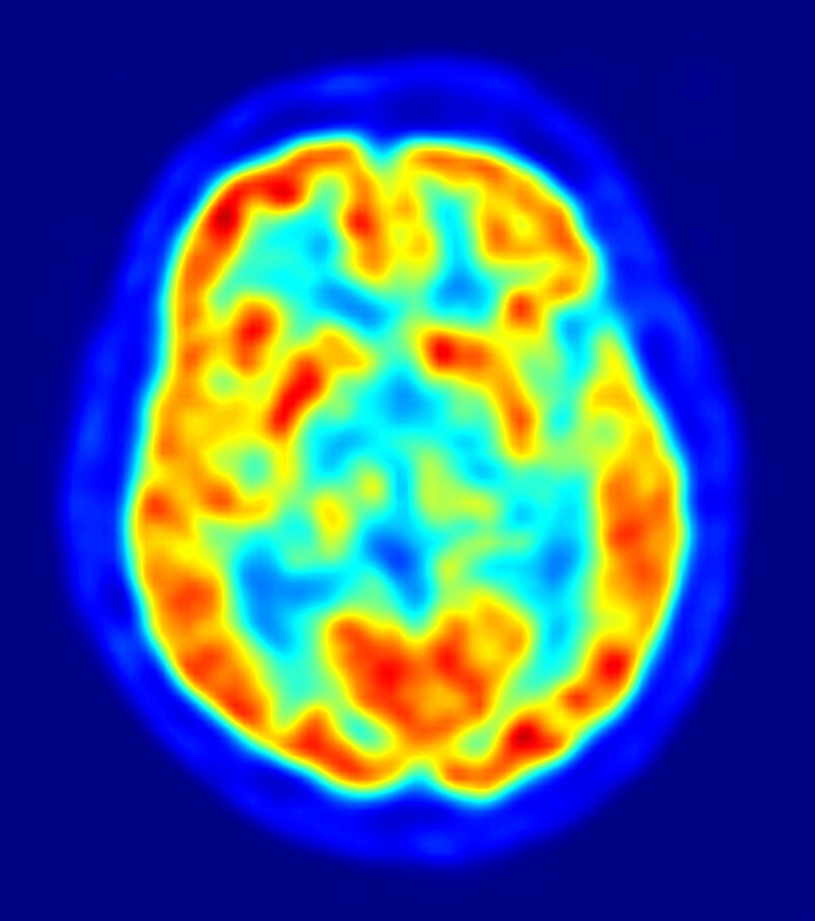 EEUU está cerca de conseguir recuperar la memoria en pacientes con Alzheimer