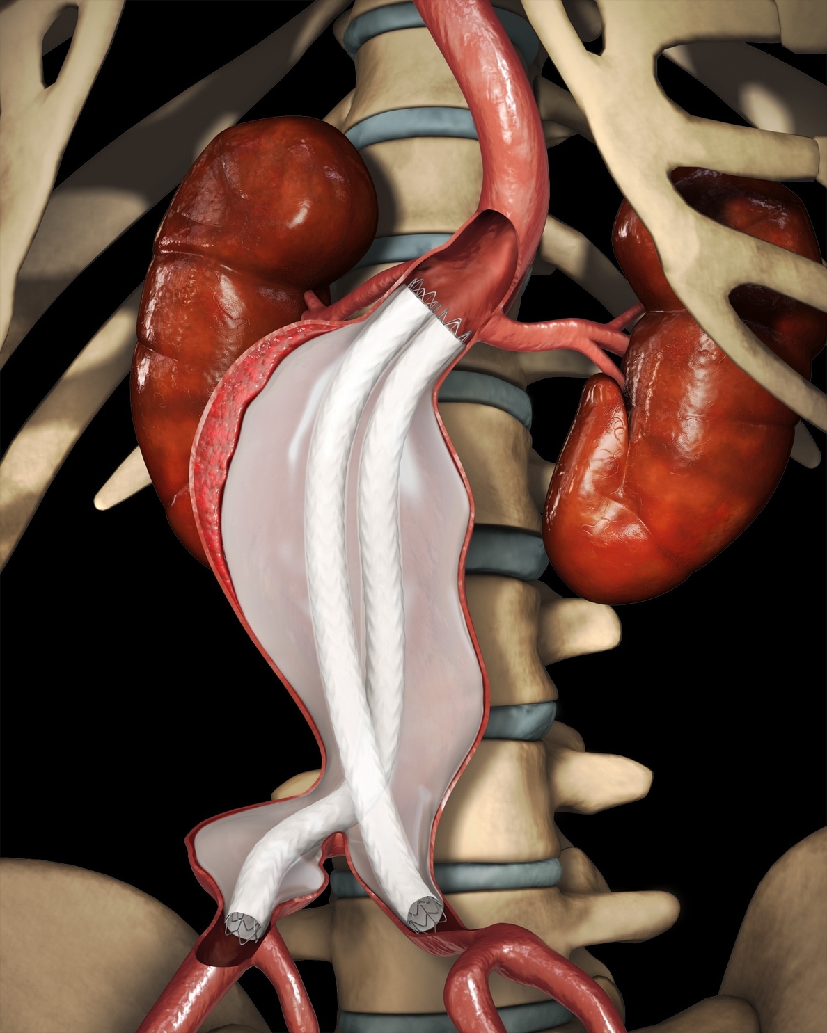 El Trueta de Girona implanta dos endroprótesis de última generación para tratar aneurismas de aorta