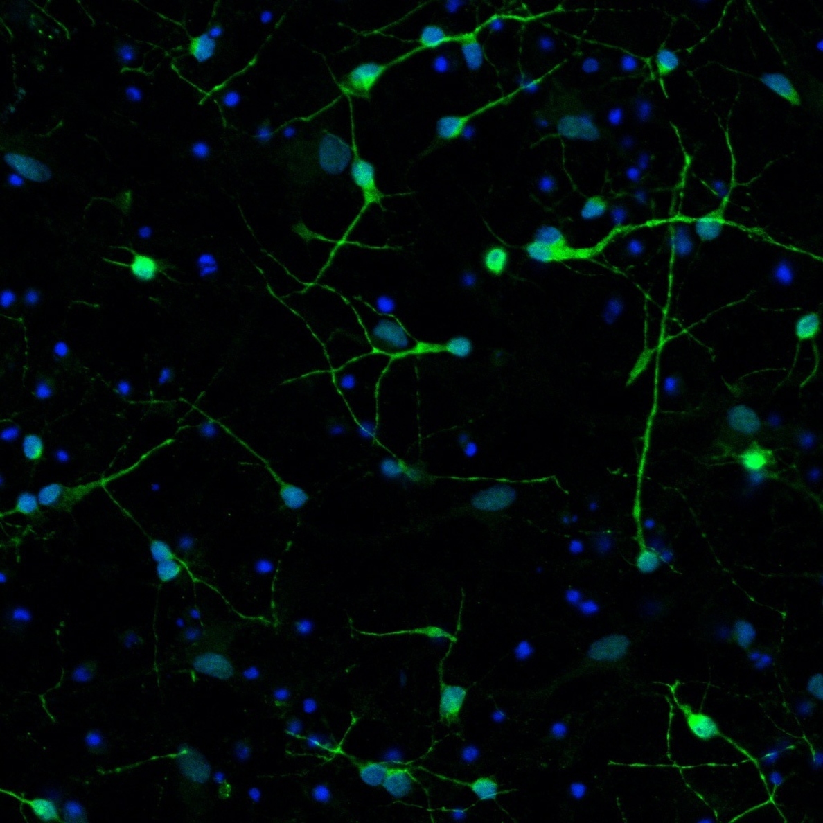 Señales neuronales rotas conducen a la neurogedeneración