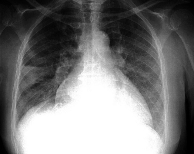 El 73% de los pacientes con enfermedad pulmonar obstructiva crónica no están diagnosticados