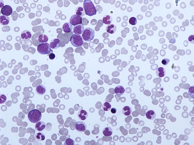 Una mutación hereditaria predispone a la leucemia linfoblástica aguda
