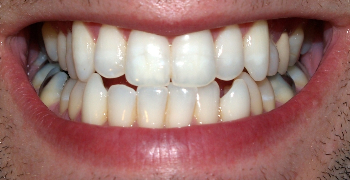 Los dientes son un «importante» banco natural de células madre