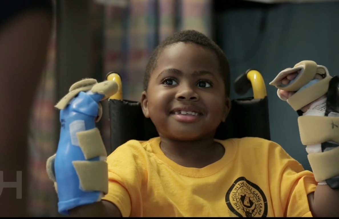 Zion Harvey, el primer niño del mundo que recibe un transplante de manos