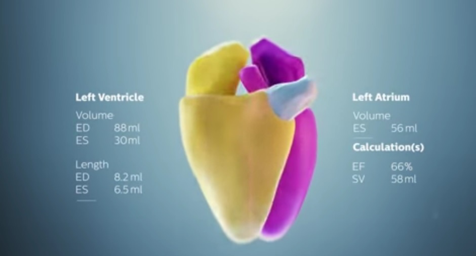 Philips presenta una herramienta de ultrasonidos con imágenes 3D para Ecocardiografía