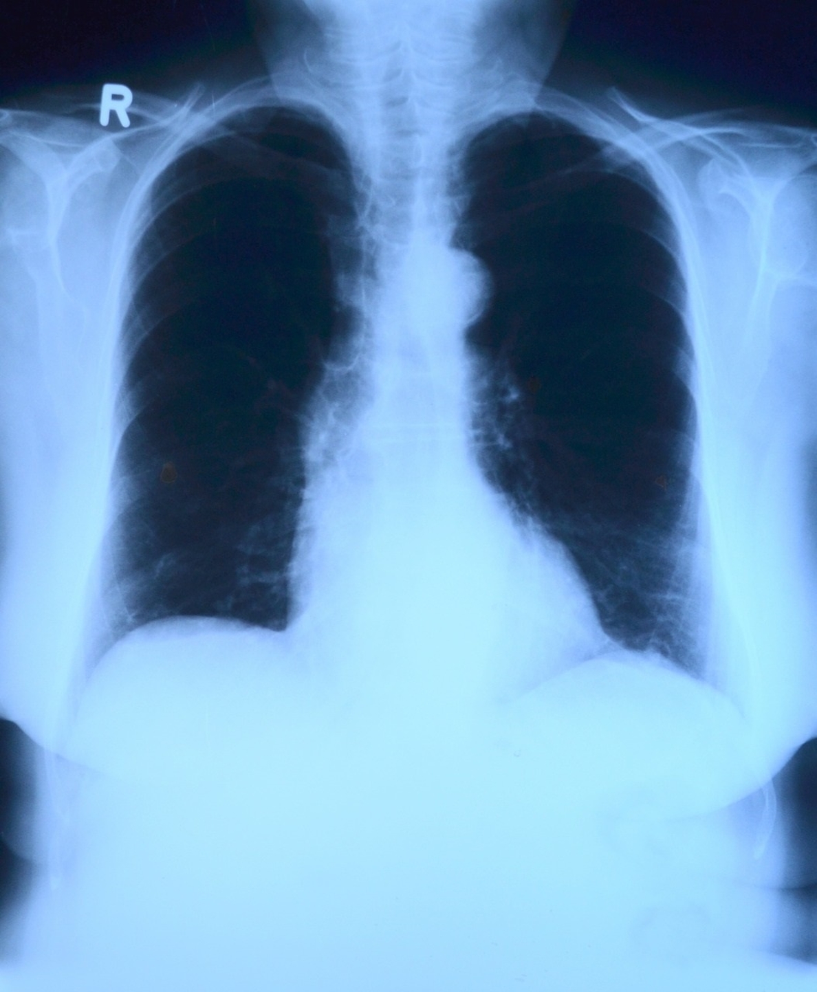 Solo un 10% de los pulmones donados terminan siendo trasplantados