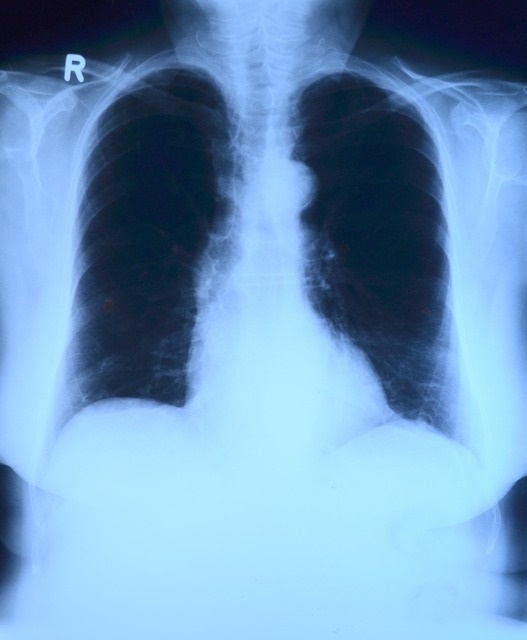 Un estudio internacional demuestra que en los últimos años ha disminuido la mortalidad por embolia pulmonar