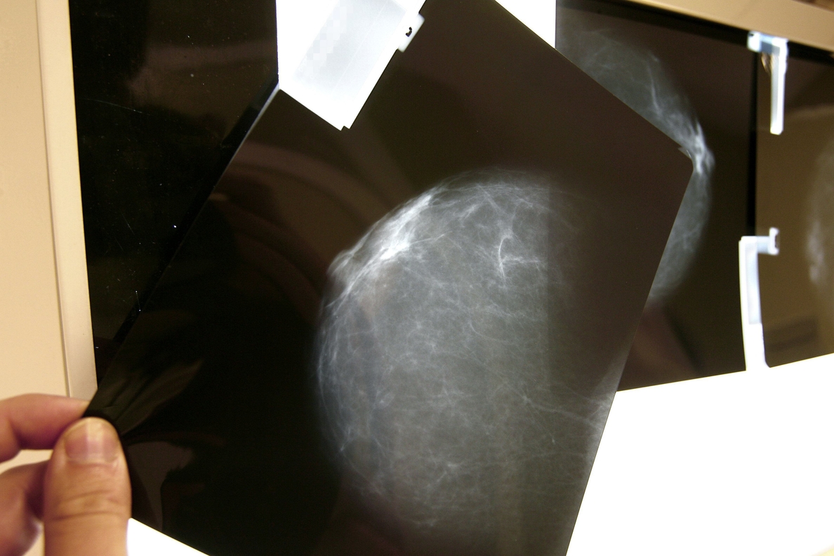 Los ginecólogos propondrán realizar la primera mamografía a los 35 años