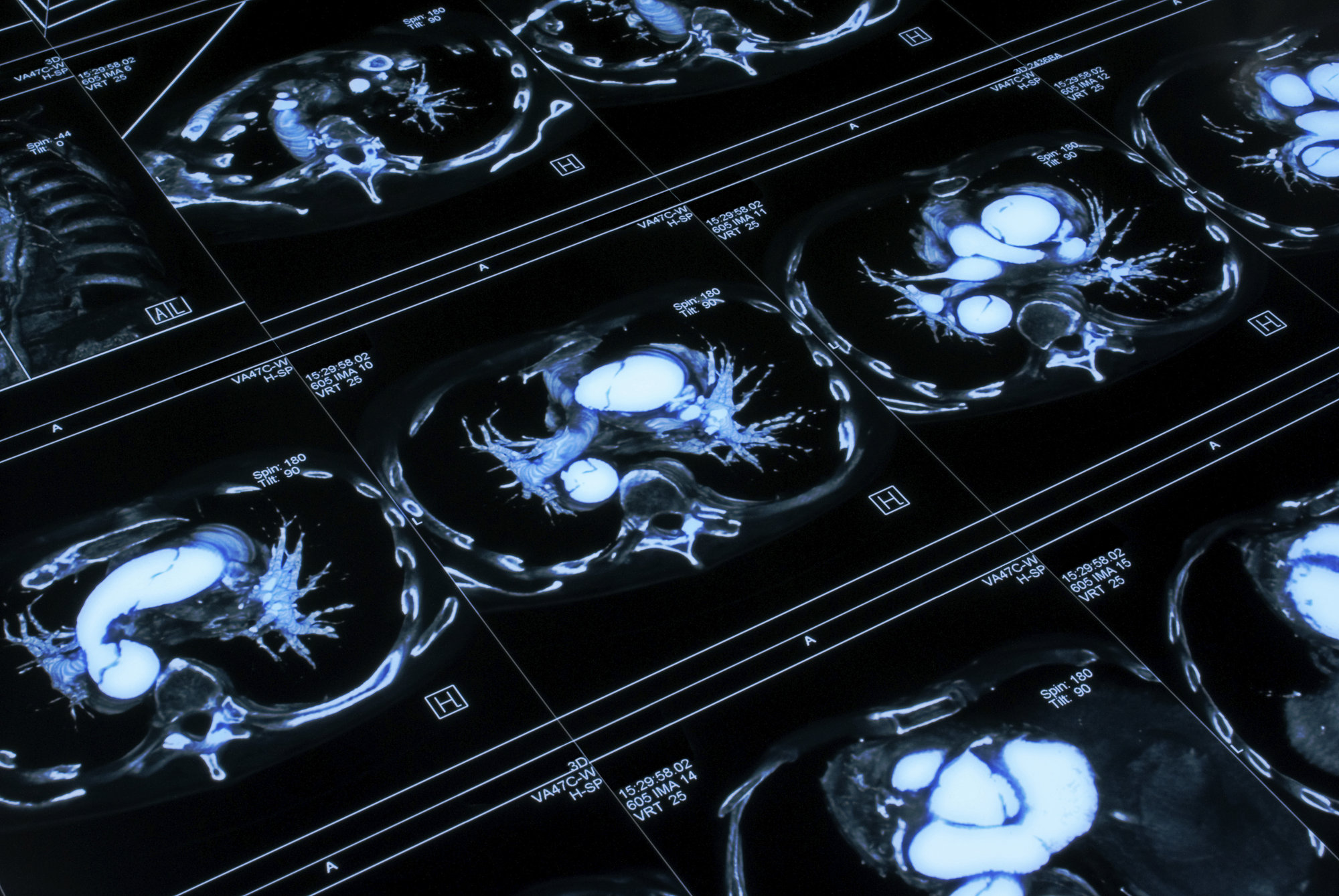 Una herramienta de inteligencia artificial ayuda a los radiólogos a detectar aneurismas cerebrales